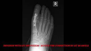 Revision Surgery for Failed #bunion Correction