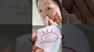 How I Tackled Sebum & Blemishes Without the Pain ~ Mediheal #blackheads #oilyskin #kbeauty #mediheal
