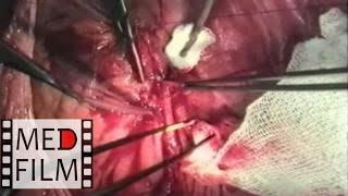 Intraoperative balloon angioplasty ©