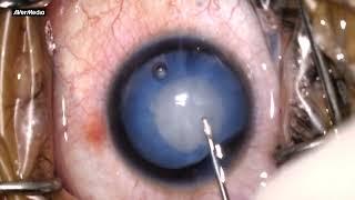 Phacoemulsification in Intumescent cataract with High myopia- Dr. Fahad, NIO