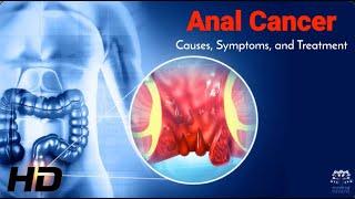 Anal Cancer Facts: What Causes It and How to Fight It