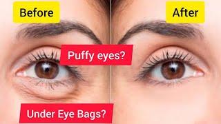 Remove Puffy Eyes, Under Eye Bags, Dark Circles & Wrinkle around Eyes naturally| Natural Tips