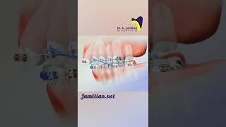 Upper Jaw Retraction Using First Molar Extraction #bracs #dentist #orthodontics #smile #extraction