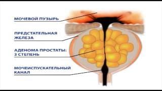 Стадии развития аденомы предстательной железы