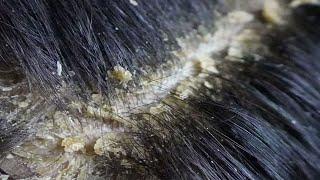 Dandruff scratching removal on head using black combing#188