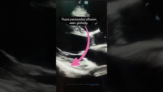 Trace pericardial effusion seen globally in 2D Echo cardiography @cardio.heart.care.drnavin