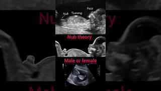 Nub theory||male or female||pregnancy #ultrasound#baby#shorts
