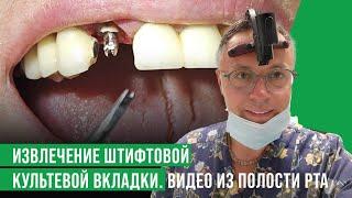 Извлечение штифтовой культевой вкладки из зуба.