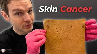 When Skin Cancer Becomes Deadly