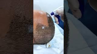 Headwash After Hair Transplant at Cara Clinic