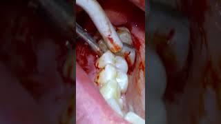 Satisfying Tooth Extraction Done By A Dentist! #Dentist #ToothExtraction