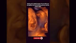 Tired Baby Yawning During a 5D Ultrasound Scan  #pregnancy #5d #ultrasound