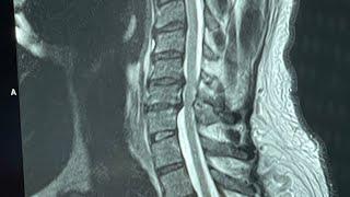 My Double C-Spine Laminectomy: C4-C5 & C5-C6 Surgery Journey