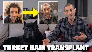 My Hair Transplant In Turkey is Life Changing! Step by Step Walk-thru