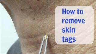 Painless Cryo Skin Tags removal - Cosmetic Institute of Australia