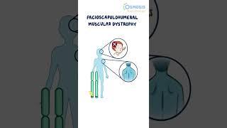 Facioscapulohumeral Muscular Dystrophy