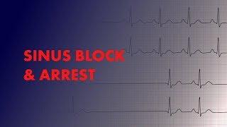 Sinus Block and Sinus Arrest - EKG (ECG) Interpretation