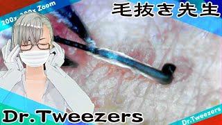 382 [200x Zoom] When do you watch this video_ Dr. tweezers 毛抜き先生の角栓や毛根