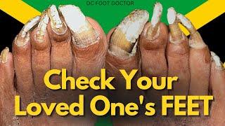 Check Your Loved One's Feet:  She's 96 and her nails need trimming
