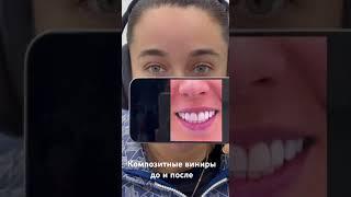 Композитные виниры до и после врач Кокуйская Ляйсан