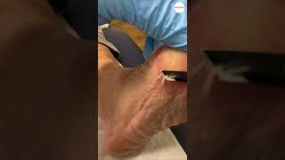 Bunion Callus Removal By Podiatrist In Podiatry Clinic