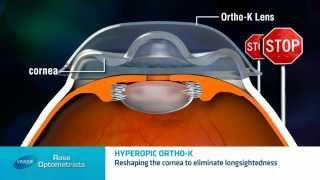 Long-sighted Ortho-keratology - Can long sighted people have Orthokeratology? Rose Optometrists