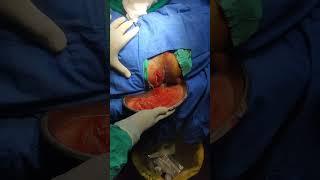 perianal abscess drainage