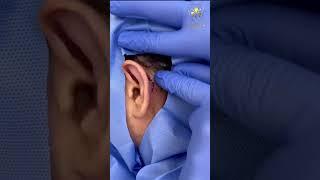 OTOPLASTY by Dr. Maen Al Khateeb- عملية الأذن الوطواطية أو البارزة مع د. معن الخطيب #shorts