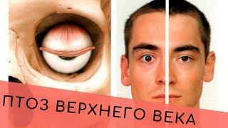 Птоз верхнего века. Упражнения