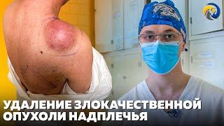 Удаление злокачественной опухоли надплечья | Операции