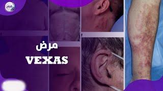 أول حالة في مصر  ..  ايه حكاية مرض VEXAS