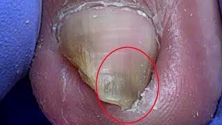 God! Such a large ingrown nail penetrates deeply, it looks painful【Doctor Liu Pedicure】