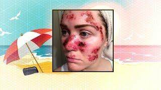 Skin Cancer Selfie Goes Viral