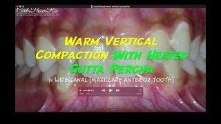 one visit endodontic treatment warm vertical compaction spesialis konservasi gigi