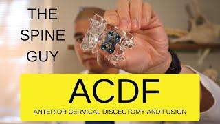 CERVICAL STENOSIS RADICULOPATHY - PART 5 - ACDF