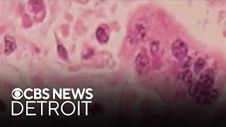 Oakland County health officials confirm measles exposure site in Rochester Hills