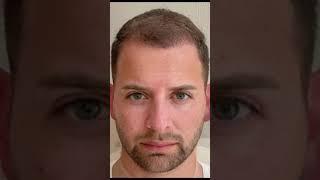 Hair Transplant Before and After | Elithair #shorts