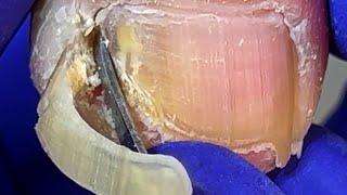 Dig out a large piece of embedded nail, pay attention to hygiene【Doctor Liu Pedicure】