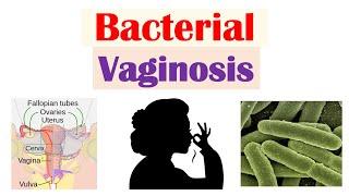 Bacterial Vaginosis (Vaginal Infection): Causes, Risk Factors, Symptoms, Diagnosis, Treatment