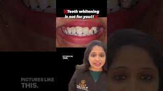 All the before after pictures of teeth whitening that you see on our profile are done on clean teeth