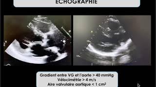 Votre opération du coeur:  le remplacement de la valve aortique pour rétrécissement aortique