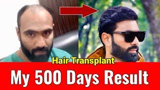 My 500 days Hair Transplant Result | Bald to Bold journey | Sahil Ayyan