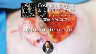 Implant Removal -  Dr. Mark Jabor I Cosmetic Surgery & Laser Center of El Paso