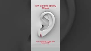 Torn Earlobe Z plasty Repair