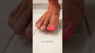 What Is An Ingrown Toenail? 