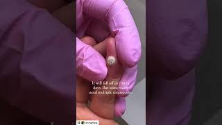 Freezing a Wart