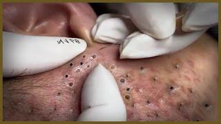 Blackhead Removal | Blackhead extraction | #blackheads