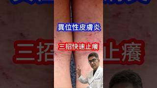 #異位性皮膚炎 #皮膚科醫生 教你三招快速止癢 #吳仁欽皮膚科診所 #屏東醫美 #567 #屏東微整 #濕疹 #搔癢 #類固醇 #乳液 #得立妥 #免疫調節藥膏 #醫立妥 #普特皮 #保濕