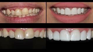 Smile Makeover. Prepless porcelain dental veneers before and after cosmetic dentistry.