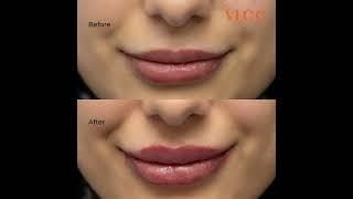 Lip Filler
